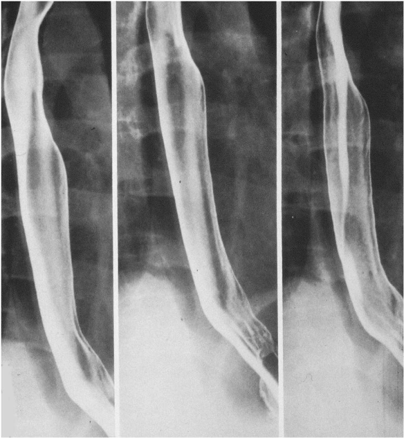 <p>barium esophagography (BA swallow, UGI series)</p>