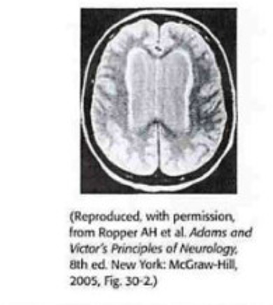 <p>Define Hydrocephalus Type:</p><p>Large spaces develop inside cortex due to loss of cortical tissue - 'cortical atrophy' - compensatory for loss of brain volume; NOT really hydrocephalus</p>