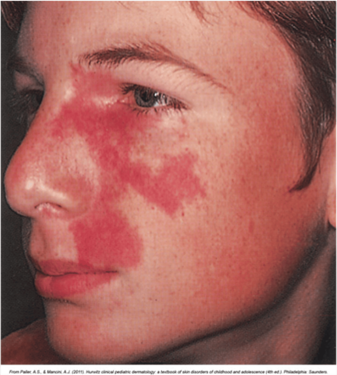 <p>type of nevus flammus that grows during childhood, thickens the skin and does not fade</p>
