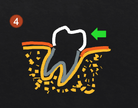 <p>mesial pocketing can be eliminated; may expose furcation </p>