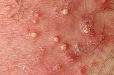 <ul><li><p><strong>Bacterial Infection:</strong></p><ul><li><p>Infection of the hair follicle, often due to follicle occlusion.</p></li><li><p><strong>Appearance:</strong> Red pustule-like, raised hair follicles.</p></li></ul></li><li><p><strong>Causes:</strong></p><ul><li><p>Poor hygiene</p></li><li><p>Contact with contaminated water</p></li><li><p>Maceration</p></li><li><p>Moist environment</p></li><li><p>Use of occlusive emollient products</p></li></ul></li><li><p><strong>Treatment:</strong></p><ul><li><p>Aggressive hygiene and warm compresses</p></li><li><p>Topical <em>Mupirocin</em> and occasionally oral antibiotics</p></li></ul></li></ul><p></p>