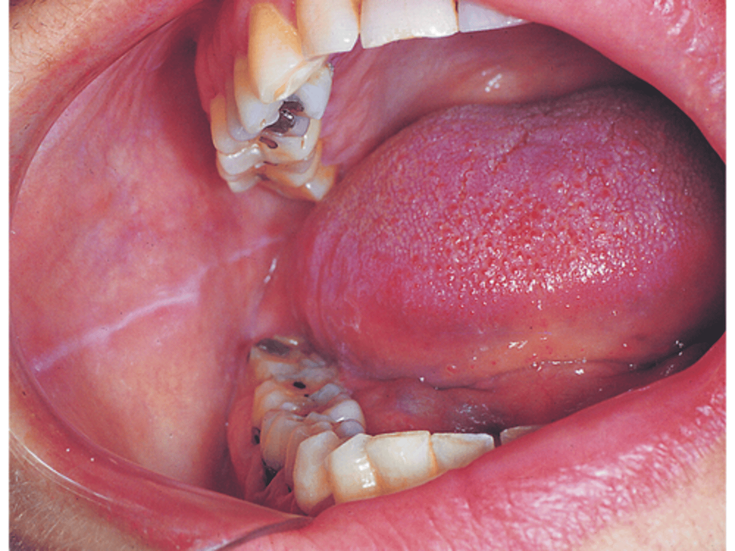 <p>White, raised line most commonly on the buccal mucosa at the occlusal plane; No treatment necessary </p>