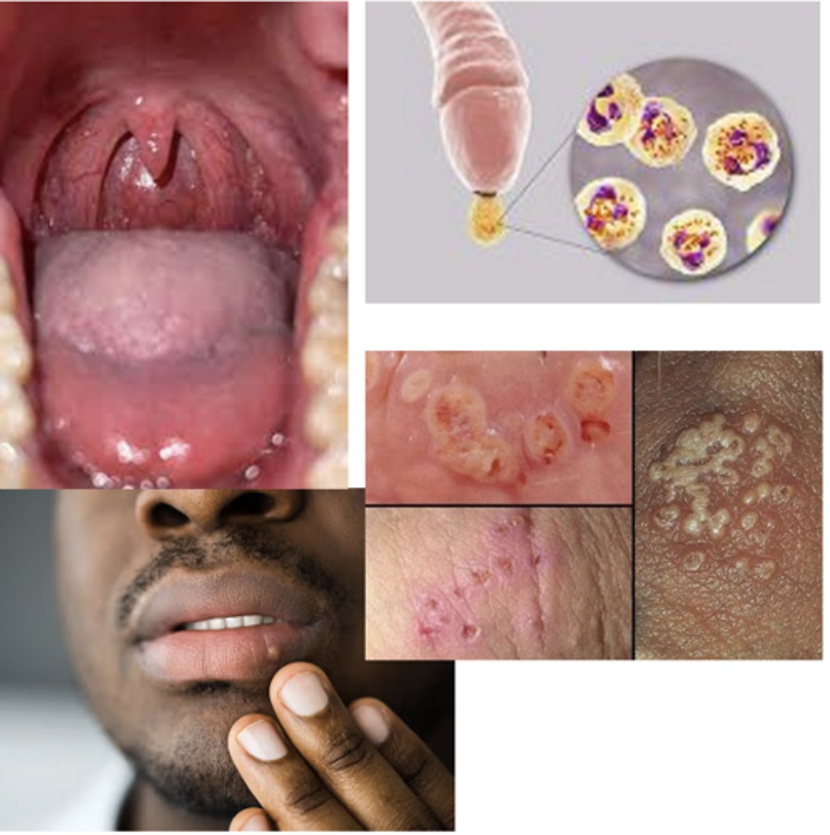 <p>What are the 4 main virulence factors of Neisseria gonorrhoeae?</p>