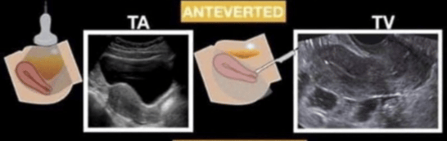 <p>the cervix forms a 90 degree or smaller anterior angle with the vaginal canal</p>