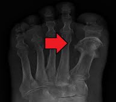 <p>Osteomyelitis</p>