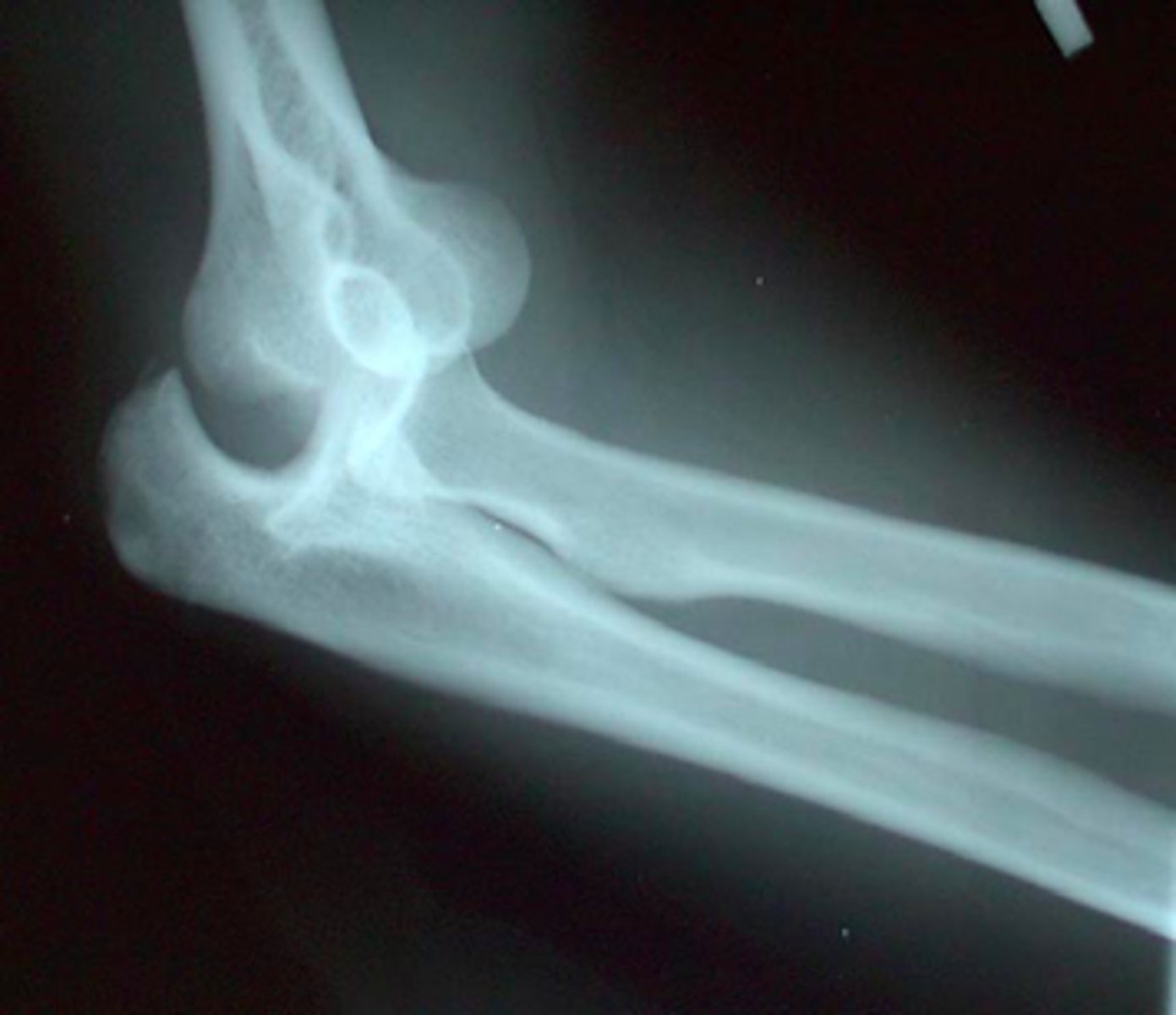 <p>what bone is dislocated in this x-ray?</p>