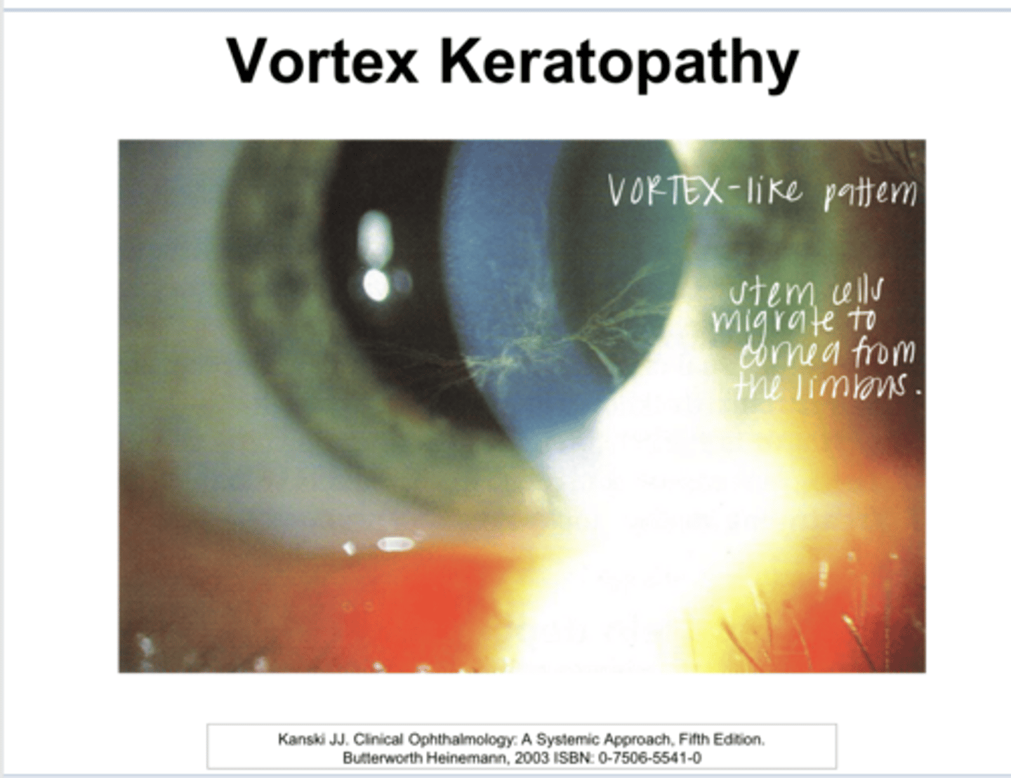 <p>What can Plaquenil (Hydroxychloroquine) cause?</p>