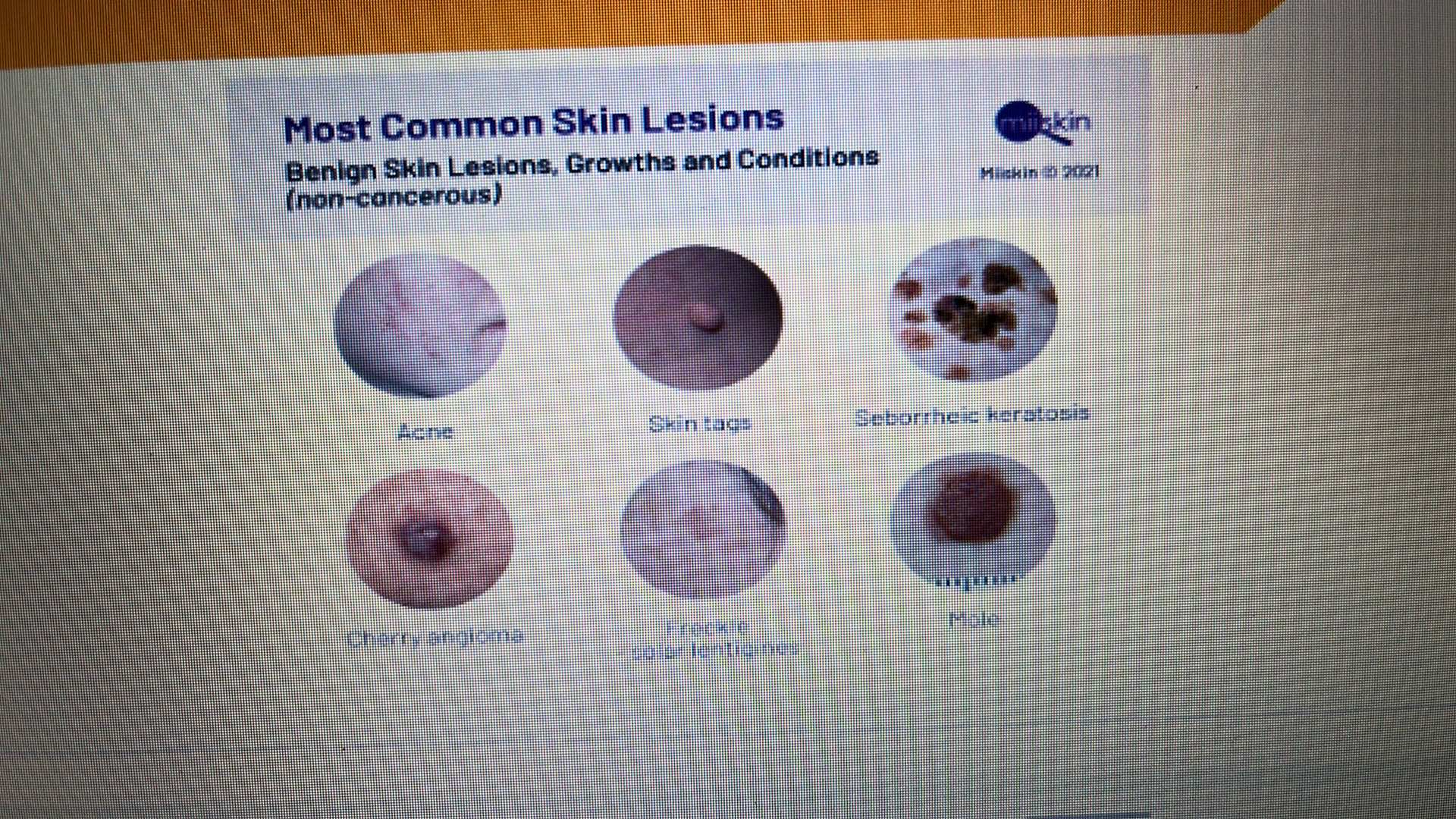 <p>SKIN DISORDER</p><p></p>