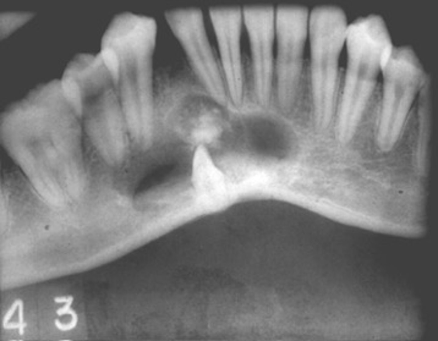 <p>ID the cyst:</p><p>•Mostly in canine-incisor area</p><p>•Well defined corticated periphery, maybe ill defined</p><p>•Internal aspect- Radiolucent periphery w/ mixed density (mixed radiolucent-radiopaque)</p><p>•Maybe associated with unerupted tooth (impeding eruption)</p><p>•May cause displacement, resorption of roots, cortical perforation</p>