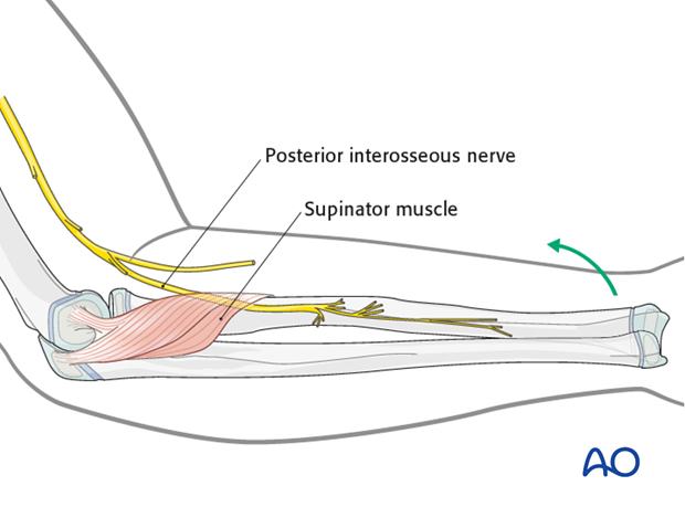 <p>The *Posterior interosseous nerve (PIN)* — branch of the Radial nerve after it passes the Supinator. ⚡ Mnemonic: "PIN powers extension."</p>