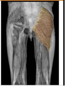 <p>Gluteus Maximus </p>