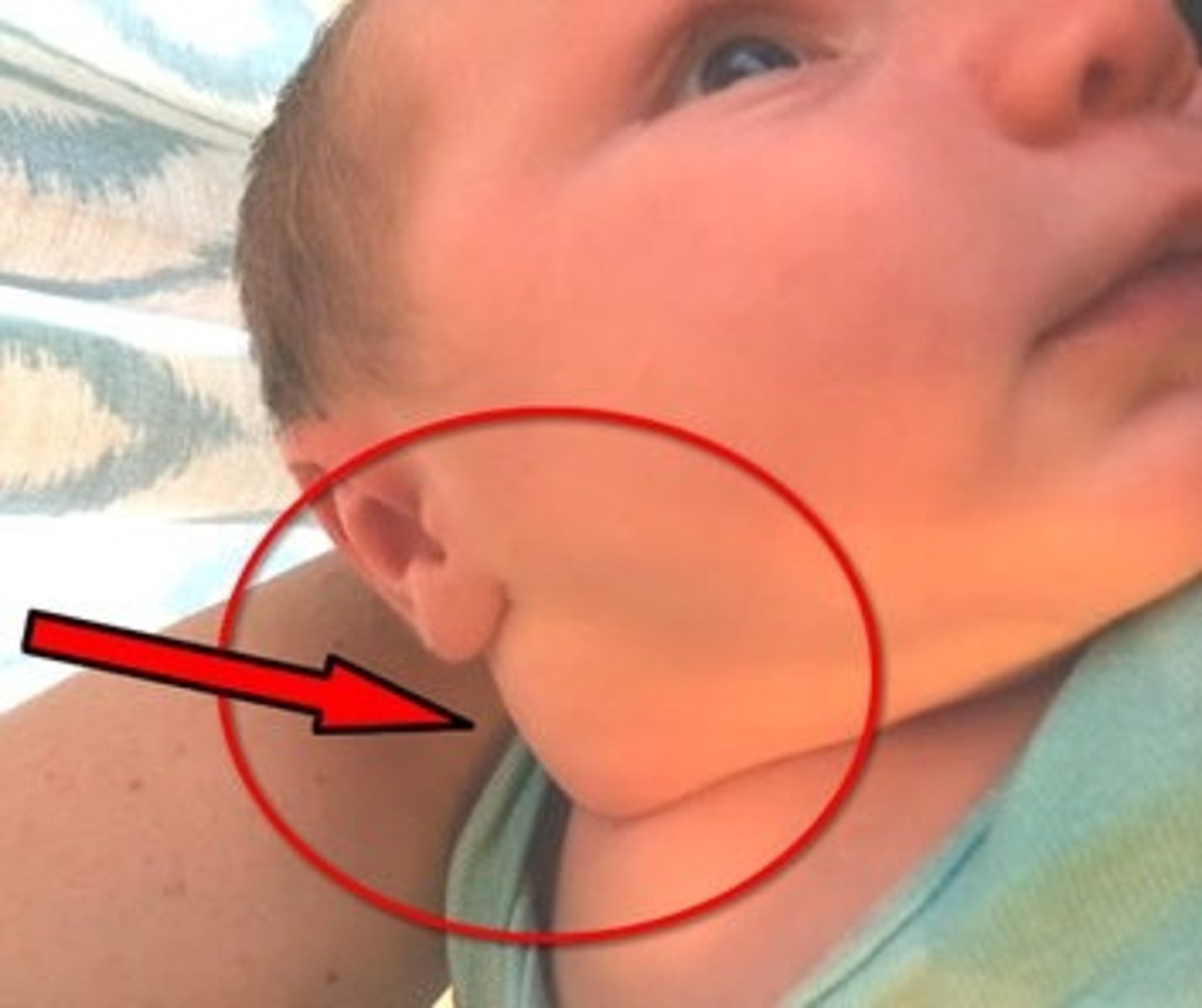 <p>- most common</p><p>- develop in SCM</p><p>- prenatal - generally occurs in a breached delivery</p><p>- results in a twisted neck from unilateral action of SCM</p><p>(this means that if the right SCM is contracted, the neck is flexed towards the right but contralaterally flex head towards the left side)</p>