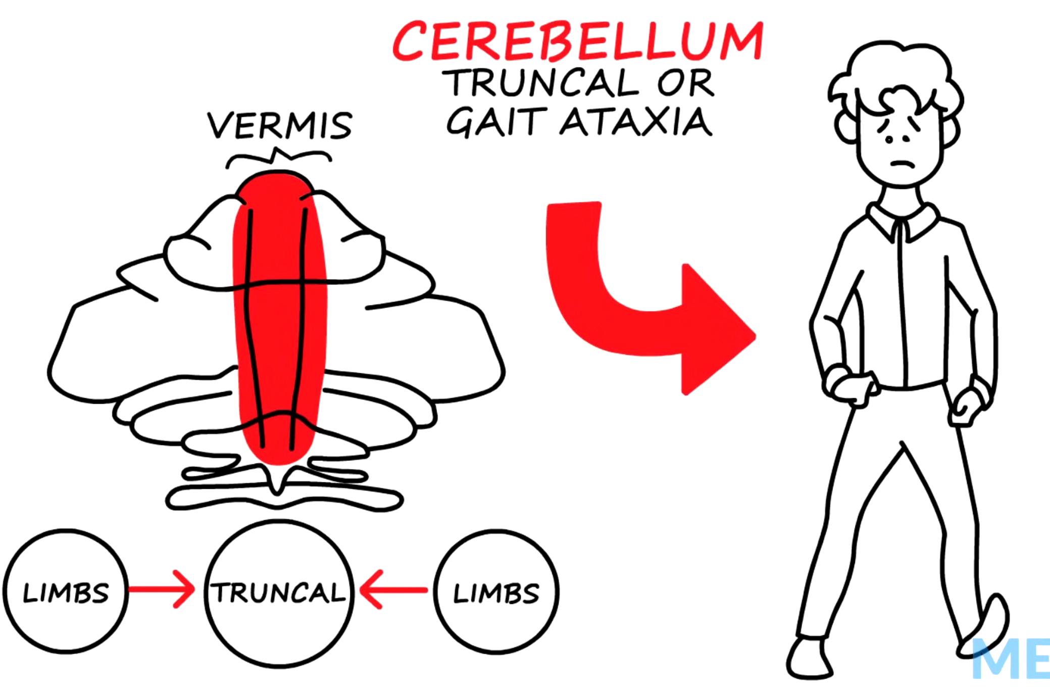 <p>Lesions in the <strong>cerebellar vermis (midline) </strong>cause a wide-based, unsteady gait, resembling a "drunklike" walk.</p>