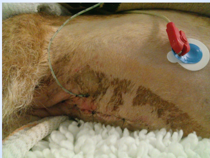 <p>Jejunostomy tube </p>