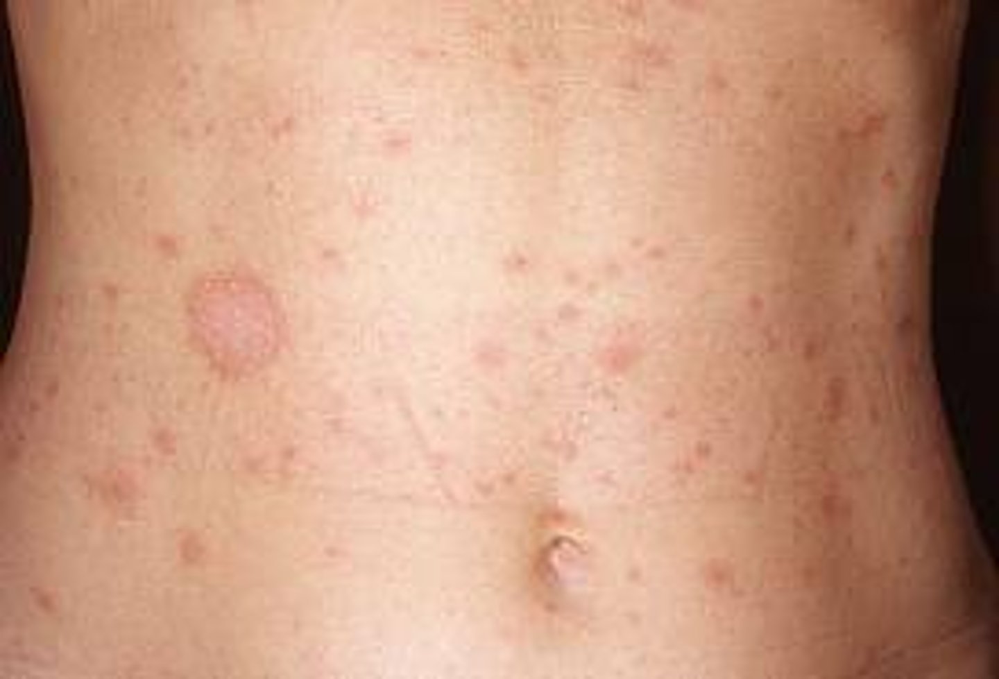 <p>dx: pityriasis rosea</p><p>tx: symptomatic only: antihistamines for itching, topical corticosteroids, oatmeal baths, UVB if severe and initiated early on</p>