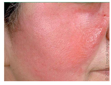 <p>acute onset of symptoms with systemic manifestations including fever and chills. Skin is raised and differentiated from uninvolved skin</p><p>treat with oral benzylpenicillin (5-7days). if penicillin allergy, 1st gen cephalosporin or a macrolide cold press, hydration</p>