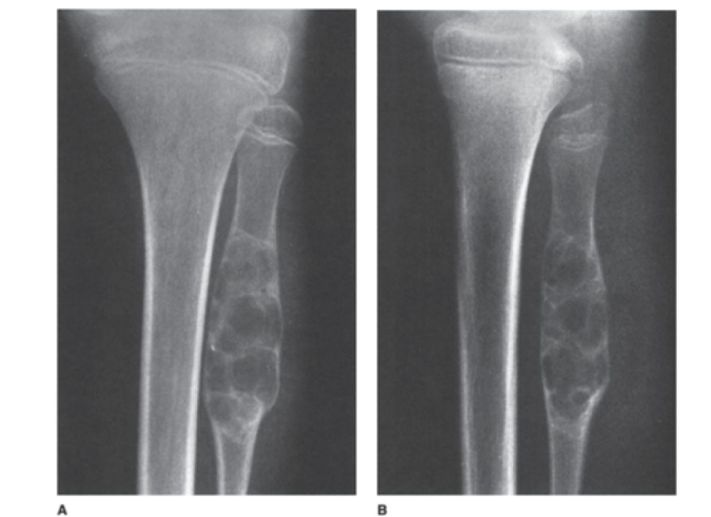 <p>Based on the history, physical examination, and radi-</p><p>ographs for Case 6-6 (Figure 6-19), which of the following choices is the best working diagnosis?</p><p>A. A bone tumor, most likely benign</p><p>B. A bone tumor, most likely malignant</p><p>C. An infection of the bone</p><p>D. A stress fracture of the proximal fibula</p>