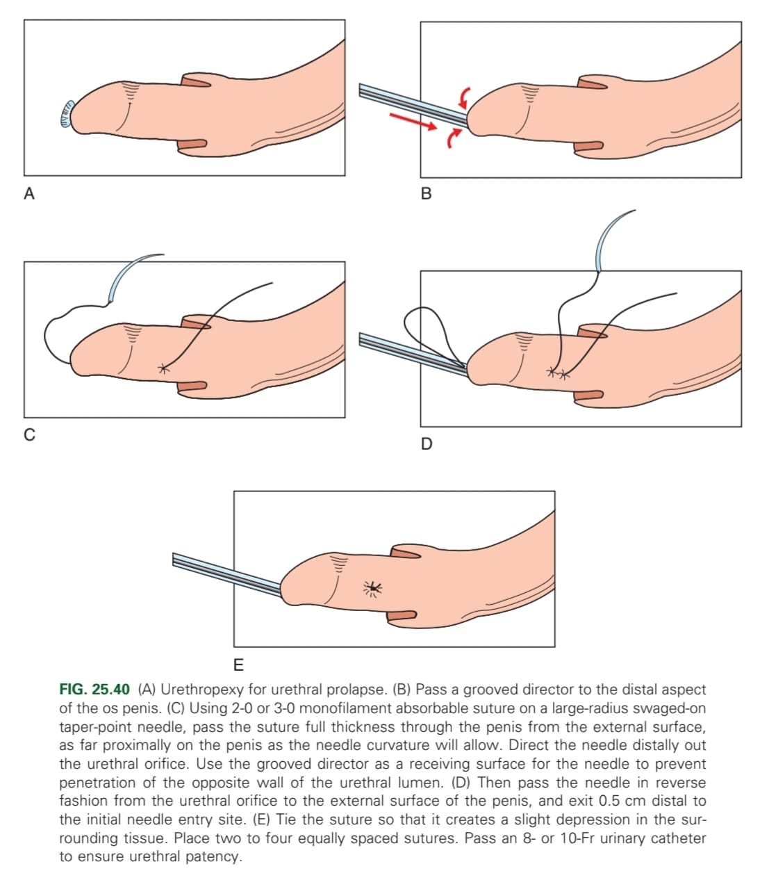 <p>Castration, urethral resection, urethropexy, antibiotics</p>