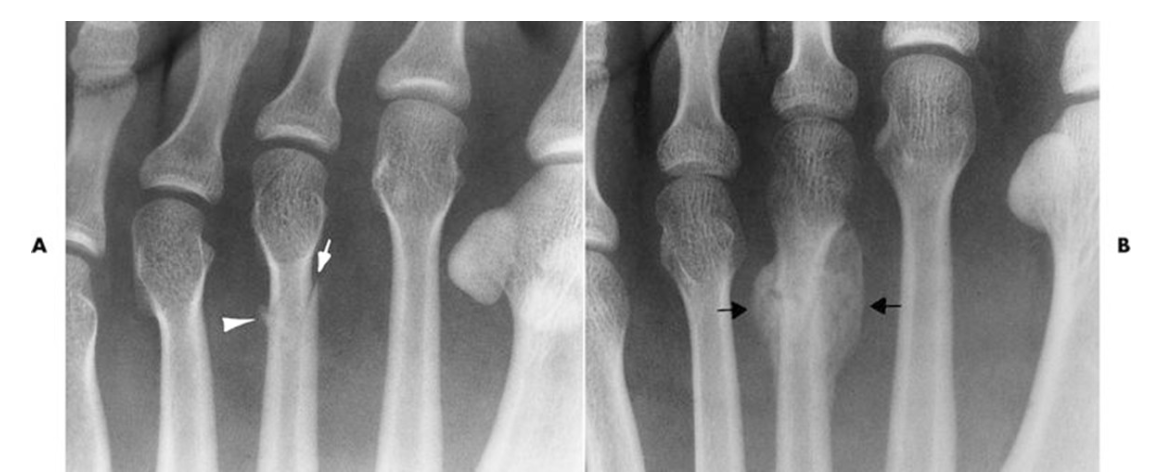 <p>What is a stress fracture? (and what are the other names for this fracture?)</p>