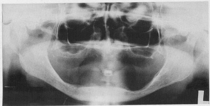 <ol><li><p>To detect any root tips, impacted teeth, cysts, tumours</p></li><li><p>to identify objects, embedded in alveolar bone</p></li><li><p>to establish position of normal anatomic landmarks </p></li><li><p>to observe quantity and quality of existing bone </p></li></ol><p></p>