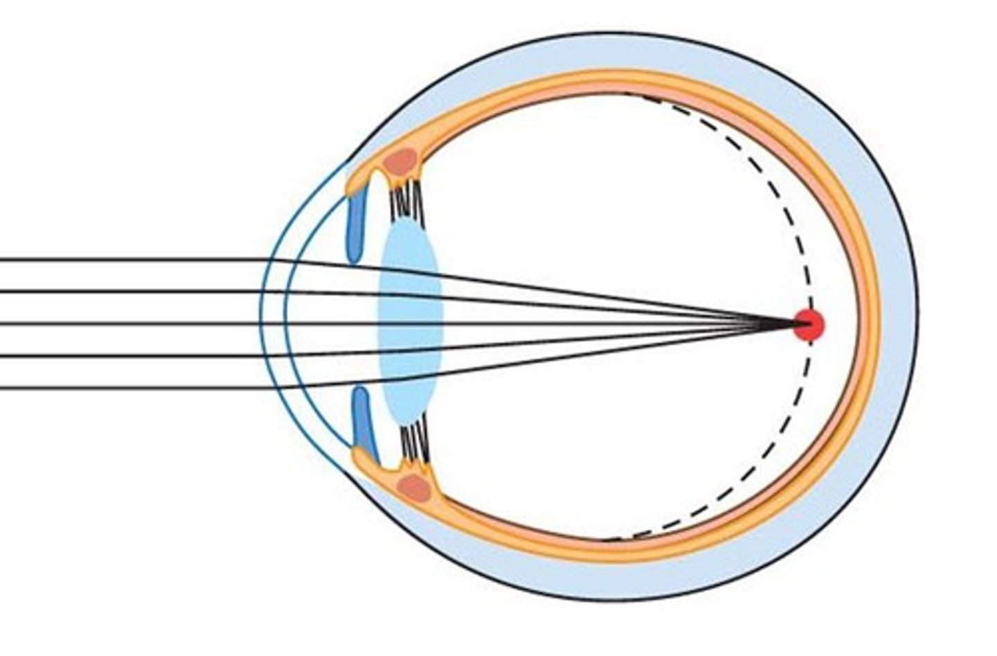 <p>-short sightedness due to light rays being focused in front of the retina</p><p>-issue is corrected using a concave lens</p>