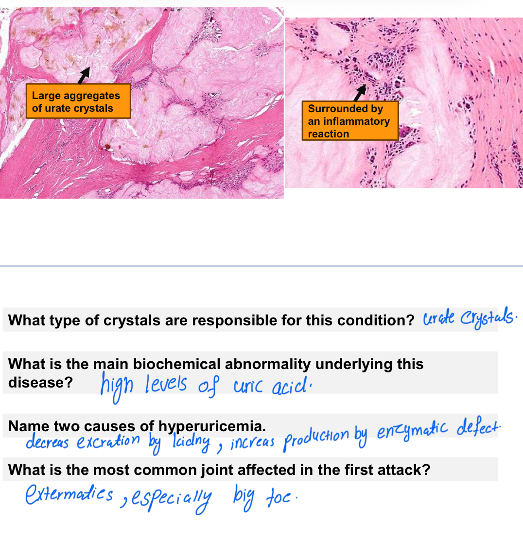<p><strong>Gout</strong></p>