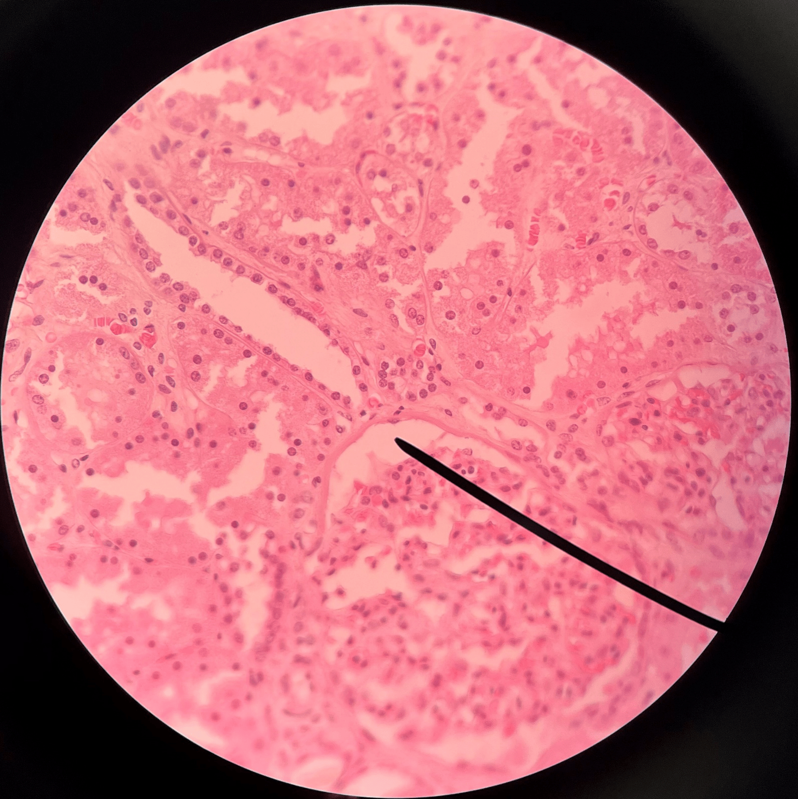• Slide histology of the nephron.

• Part of a renal corpuscle.

• The interior of the glomerular capsule.