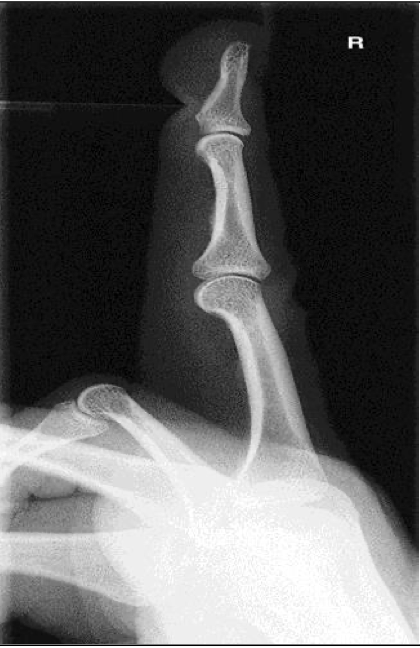 <p><span style="line-height: normal;">• </span>Entire finger and MCP joint demonstrated</p><p class="p1"><span style="line-height: normal;">• </span>CR centered at PIP</p><p class="p1"><span style="line-height: normal;">• </span>Collimation includes entire finger and at least MCP joint</p><p class="p1"><span style="line-height: normal;">• </span>True lateral position</p><ul><li><p class="p1"><span style="line-height: normal;"> </span>Anterior aspect is concave</p></li><li><p class="p1"><span style="line-height: normal;"> </span>Posterior aspect is straight or slightly convex</p></li></ul><p class="p1"><span style="line-height: normal;">• </span>Digit parallel to IR</p><ul><li><p class="p1"><span style="line-height: normal;"> </span>IP and MP joints are open spaces</p></li></ul><p></p>