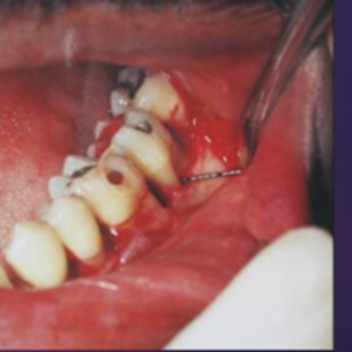 <p>what is being measured in regards to the probe?</p><p>a. recession</p><p>b. pocket depth</p><p>c. furcation involvement</p><p>d. clinical attachment level</p>