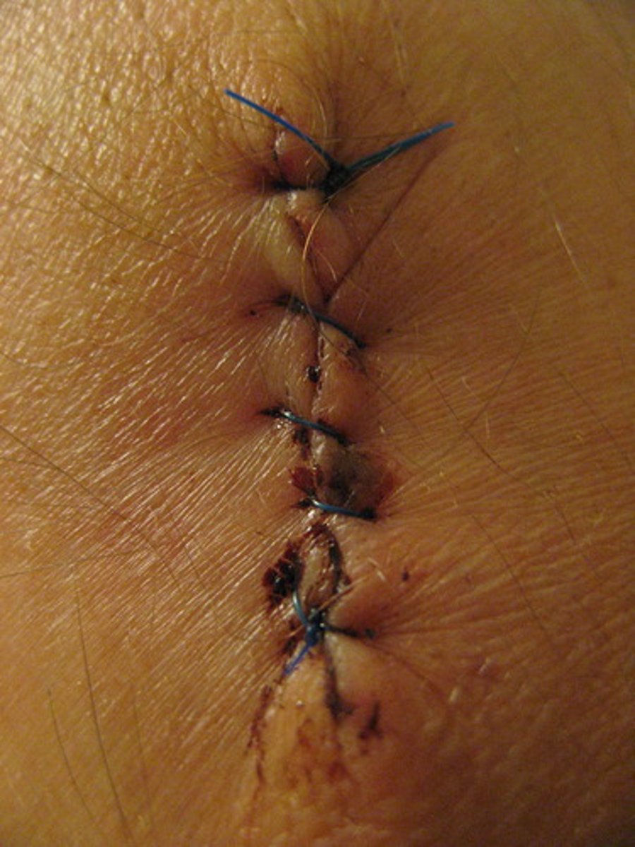 <p>suturing, repairing</p>