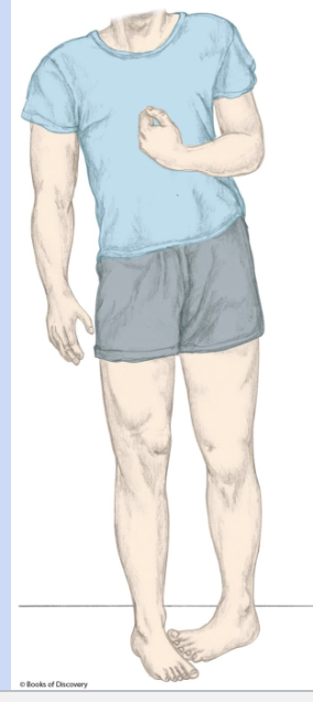 <p>can occur from CVA or TBI </p><p>abnormal muscle tone, weakness, paralysis</p><p>can lead to vestibular, visual, or somatosensory issues</p>