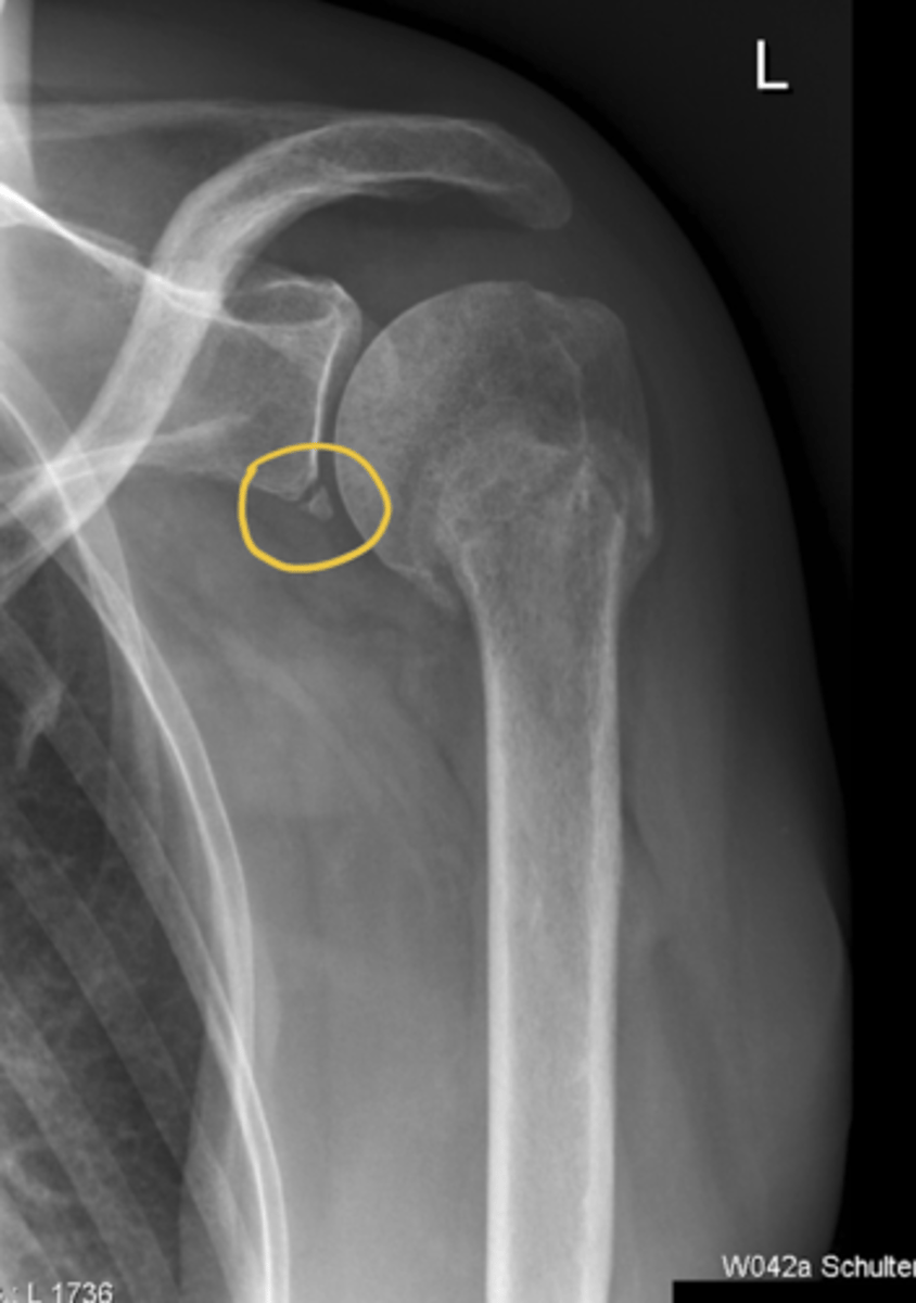 <p>Bony Bankart lesion (i.e., an avulsion of the capsulolabral tissue from the anteroinferior glenoid rim)</p>