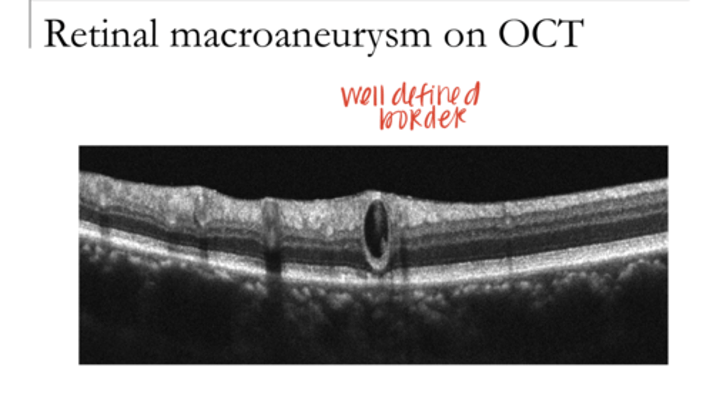 <p>Retinal Macroaneurysm on OCT (Pic)</p>