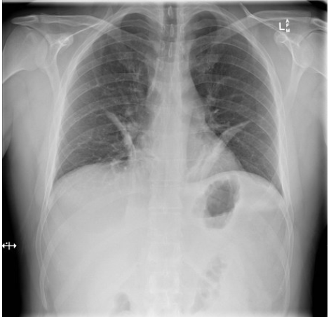 <ul><li><p>diaphragm elevation on the collapsed side </p></li></ul><ul><li><p>deviation of the mediiastinum, trachea (deviated towards collapsed side</p></li><li><p>increased density of the lobe</p></li></ul><p></p>