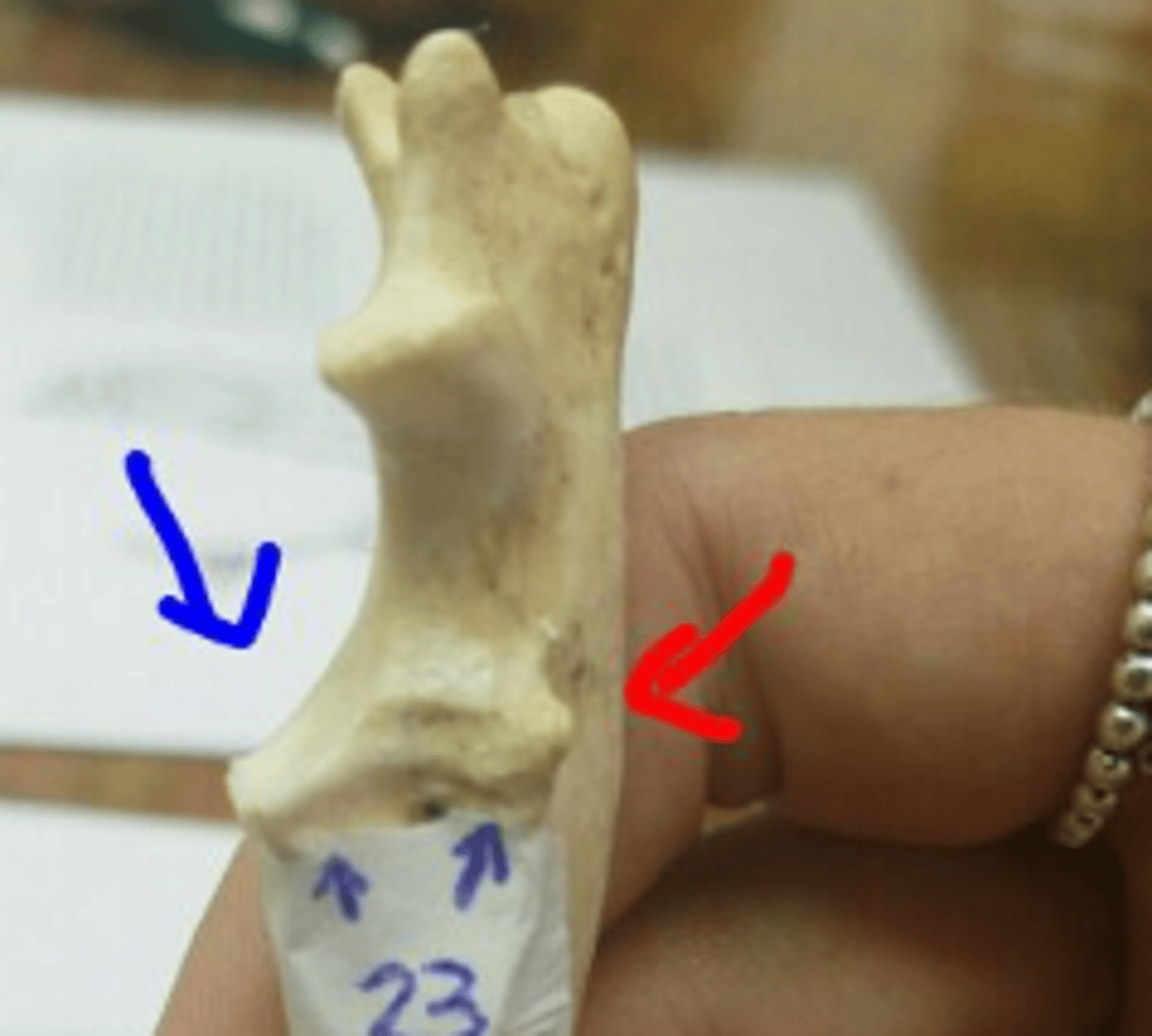 <p>at the distal end of the trochlear notch on the ulna; articulate with the humerus and radius. Medial is larger (in blue)</p>