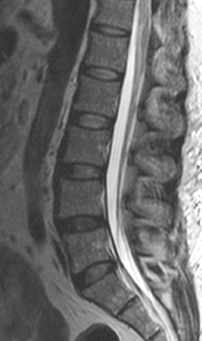 <ul><li><p>extension of pia mater</p><ul><li><p>long, thin strip of CT</p></li></ul></li><li><p>extens inferiorly from conus medullaris</p></li><li><p>anchors cord to coccyx</p></li></ul><p></p>