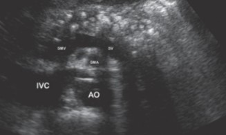 <p>This patient has been getting follow up USs regarding their pancreatitis. The patient has a history of consuming large amounts of alcohol. What can be assumed here?</p>