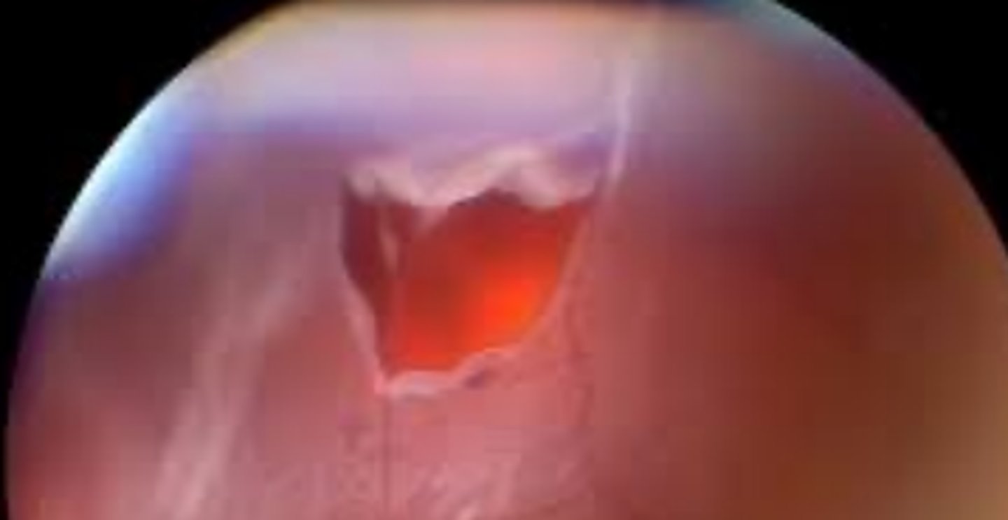 <p>a full thickness sensory retina break that can be caused by vitreo-retinal adhesions or trauma. The base of the tear remains attached to the RPE whereas the free end remains attached to the vitreous being pulled and being a large risk for retinal detachment.</p>