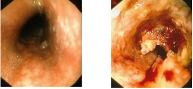 <p><strong>Esophageal Cancer: Squamous Cell Carcinoma</strong></p><p>-Epidemiology → men > women</p><p>-Risk Factors → ____, _______, achalasia/strictures, and tylosis </p><p>-Pathogenesis → located in ___ to _____ esophagus </p><ul><li><p>Arise from small ______, denuded epithelium, or plaques </p></li><li><p>Advanced lesions → infiltrating and ulcerated mass</p></li><li><p>______ lymph node invasion</p></li><li><p>Metastases → liver, bone, lung</p></li></ul><p></p>