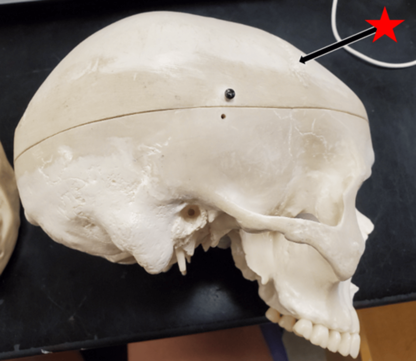 <p>Name the suture the arrow is pointing to in the image.</p>