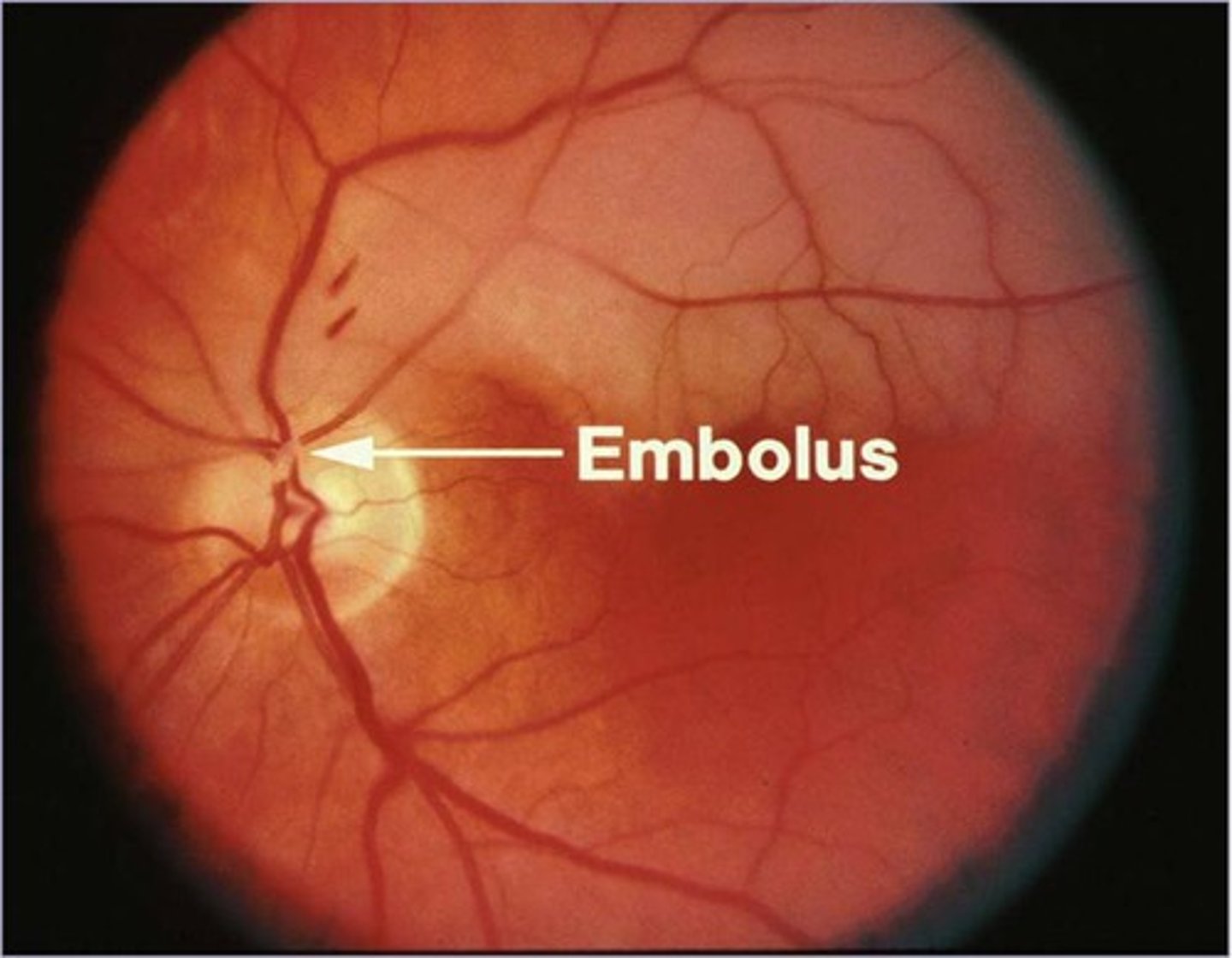 <p>← embolic occlusion of the main retinal artery or the upper or lower divisions</p><p>- Transient monocular blindness</p><p>- Temporary loss of vision in one eye</p><p>- "window shade coming down" or grey shading of vision</p><p>- Lasts minutes then resolves</p>