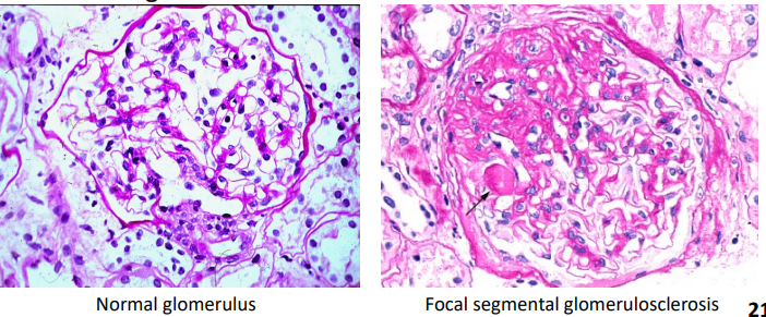 <p>Compare the glomeruli in these light microscopy images:</p><ul><li><p>Deposition of excess matrix (pink material)</p></li><li><p>Rest of glomerulus looks normal</p></li></ul><p></p>