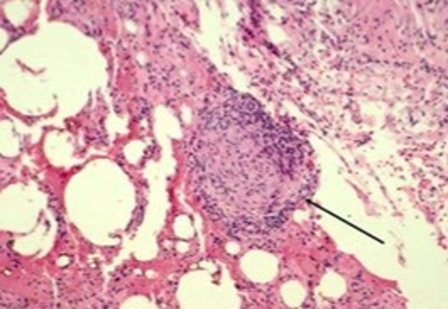 <p>Beryllium lymphocyte proliferation test (only available at a few major medical centers in the whole US) or biopsy; treated w/ oral corticosteroids</p>