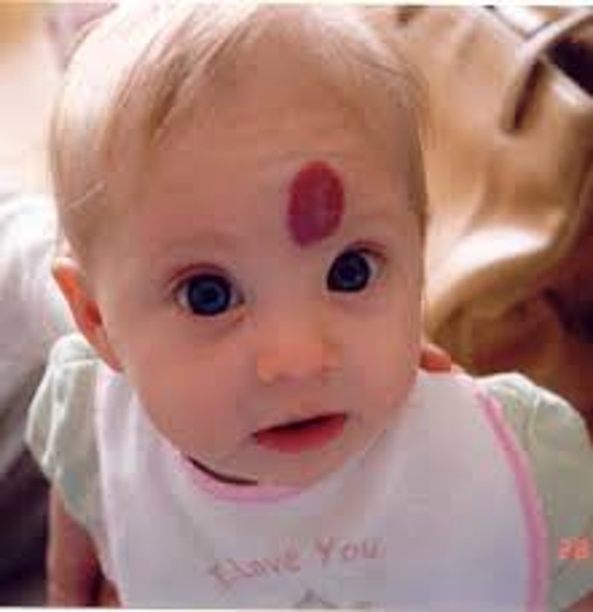 <p>Abnormal accumulation of blood vessels in the skin; one of the most common birthmarks</p>