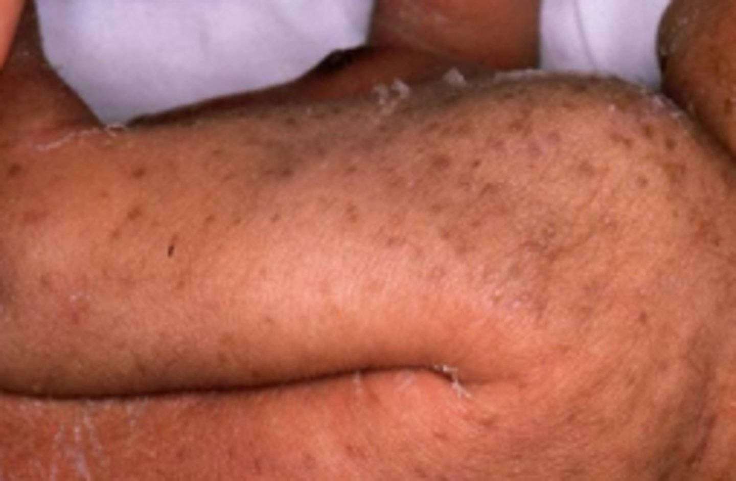 <p>present at birth </p><p>hyperpigmented macules </p><p>persists for months</p>