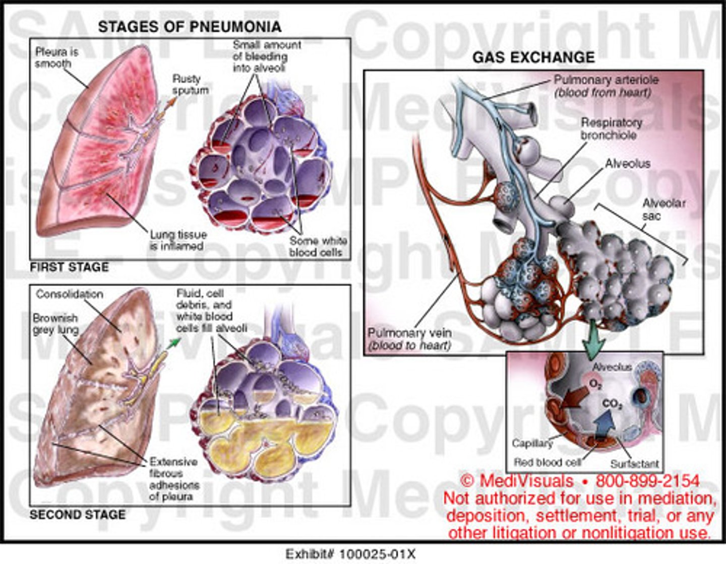 <p>-Streptococcus pneumoniae<br>-Shaking chills, high fever, cough, sputum production (tinged with blood), chest pain (5-10d duration)<br>-Lobar pneumonia w/ air-space consolidation (physical exam & radiagraphically)</p>