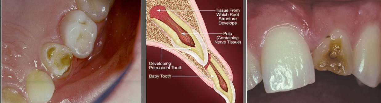 <p>Common causes:</p><ul><li><p>Fever</p></li><li><p>Periapical inflammatory disease of overlying deciduous tooth</p></li><li><p>Trauma</p></li></ul><p>Clinical: Enamel can be white, yellow, brown and/or have different degrees of hypoplasia</p><p>Location: Most common in bicuspids because of their relationship with the deciduous molars</p><p></p>