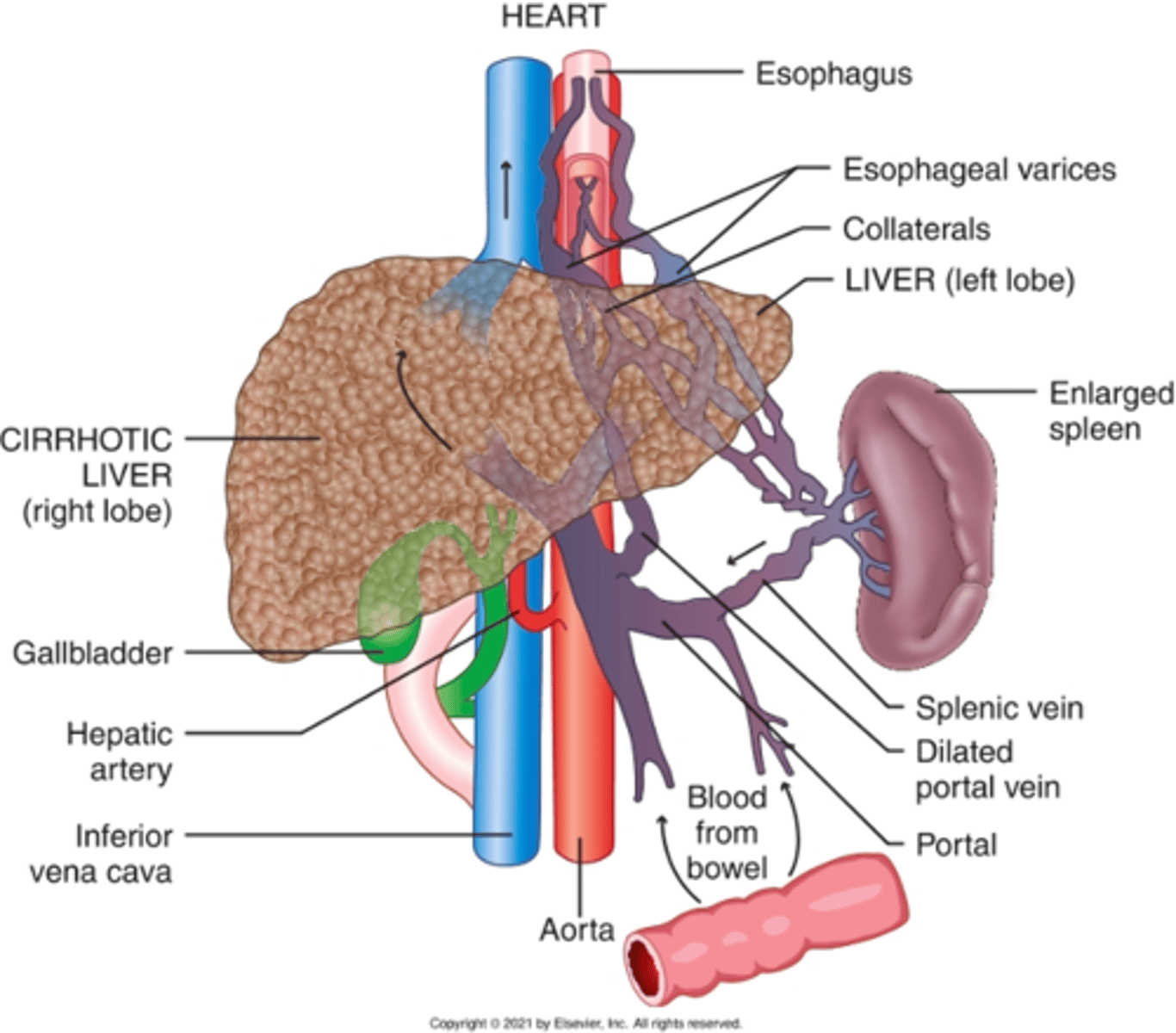 <p>1. Cirrhosis (poor blood movement)</p><p>2. Intrahepatic blood flow obstructions</p><p>3. Systemic circulatory compromise</p><p>Sx:</p><p>- Ascites (fluid is pushed out of liver bc of buildup)</p><p>- Esophageal varices (shunted)</p><p>- Hepatomegaly</p><p>- Elevated transaminases</p><p>Blood is not in all areas of liver; some back flow and some pooling in liver</p>