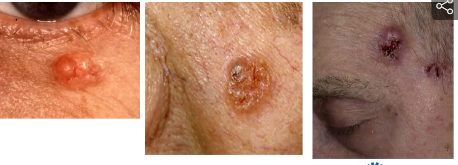 <p>Meest voorkomende variant van BCC.</p><ul><li><p>Heeft als kenmerk een glimmend oppervlak (parelmoerglas) waar kleine vaatjes zitten over de tumor. De term voor kleine vaatjes: teleangiëctase</p></li><li><p>Nodulair histologisch beeld</p></li></ul><p></p>