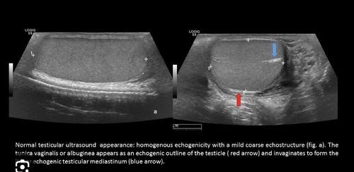 <p>What is the echogenicity of the <span><span>mediastinum testis?</span></span></p><p>Low-level echoes</p><p>Medium-level echoes</p><p>High echogenicity</p><p>It cannot be identified on ultrasound.</p>